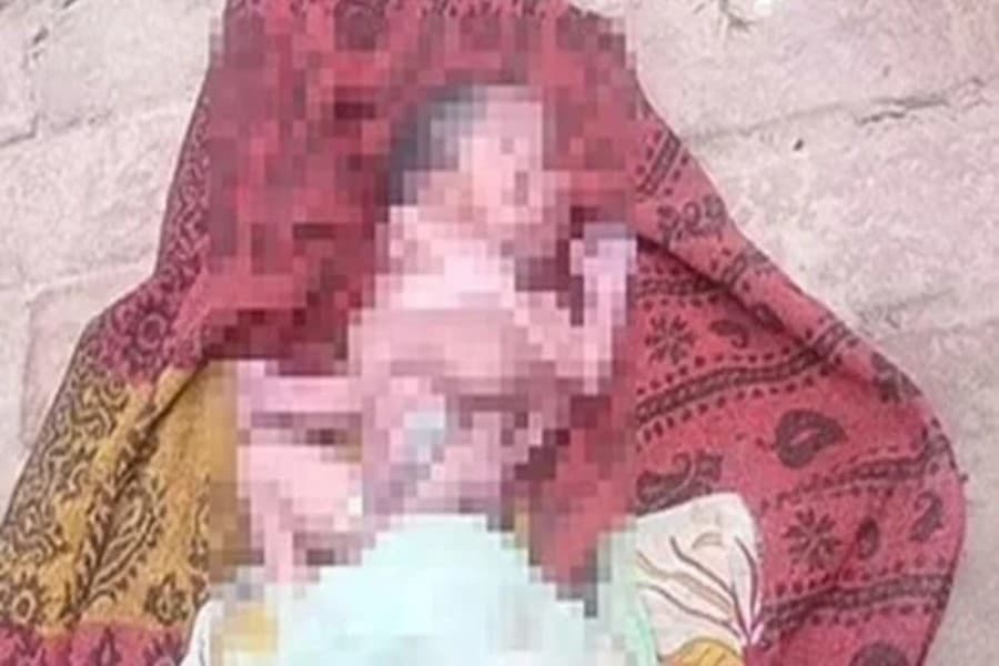 Hindistanda şok anomaliyalarla uşaq dünyaya gəlib