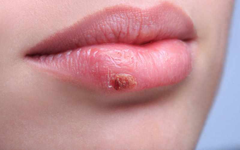 Herpes virusunun beyinə təsiri: ARAŞDIRMA