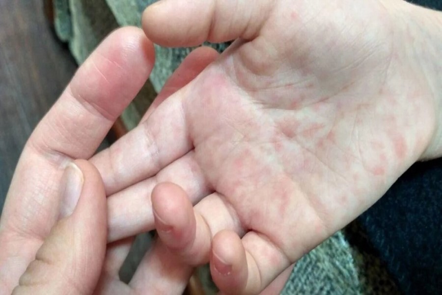 Avropada qızılca: Xəstəliklər artdıqca ÜST təcili peyvənd etməyə çağırır