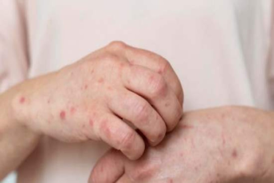 Qızılca təhlükəsi geri qayıdır: Epidemiyalar artır