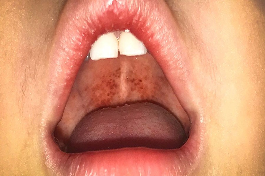 İngiltərədə "Strep A"-dan ölənlərin sayı 122-yə çatır - ÖZƏL