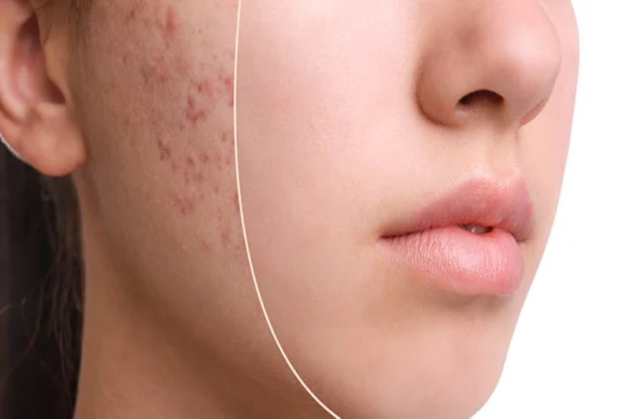 Dermatoloqlar: Sızanaq üçün pəhriz mənasızdır