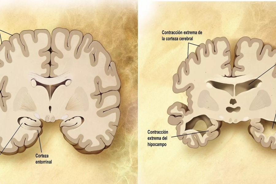 Göbələk infeksiyalarının Alzheimer simptomlarına səbəb ola biləcək